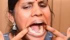 عکس | زن هندی با ۶ دندان اضافه، رکورد گینس را شکست!