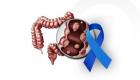 مارس شهر التوعية بسرطان القولون والمستقيم.. الأعراض وطرق الوقاية (خاص)