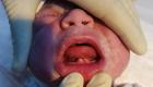 تولد یک نوزاد در عراق با دندان‌های شیری!