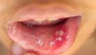 سرطان الفم والحلق.. 8 أعراض بينها "البقع البيضاء"