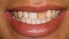 موت الأسنان.. الأسباب والأعراض وطرق العلاج