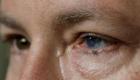 آمریکایی‌ها نابینایی یک چشم را با پیوند سلول بنیادی از چشم دیگر درمان کردند
