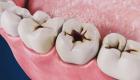 3 نصائح للوقاية من تسوس الأسنان