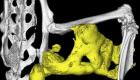 سقالات بلاستيكية ثلاثية الأبعاد.. تطوير أداة تعيد تجديد أنسجة العظام
