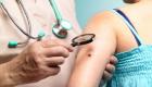 علاج جديد لأخطر أشكال سرطان الجلد.. يقلل خطر الوفاة للنصف