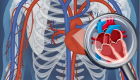 Aort damarı yırtılması nedir, neden olur?