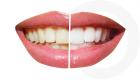 Diş Beyazlatma Ürünlerinin Zararları