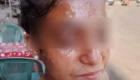 مأساة كارولين «طالبة فيصل».. معلمة مصرية تحرق وجه تلميذة بمياه مغلية