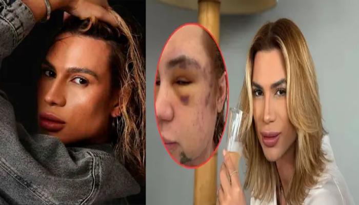وفاة مؤثر برازيلي بعد خضوعه لعملية تجميل