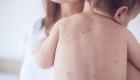 الولايات المتحدة تسجل أولى الإصابات المحلية بسلالة خطيرة من الجدري المائي