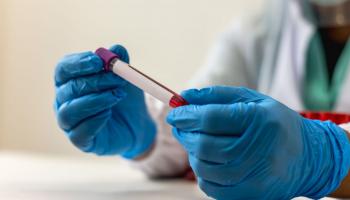 علماء روس يبتكرون تقنية تعزز فعالية علاج سرطان الدم