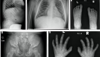 مرض موركيو يسبب مشكلات متعددة في القلب والعينين والمفاصل