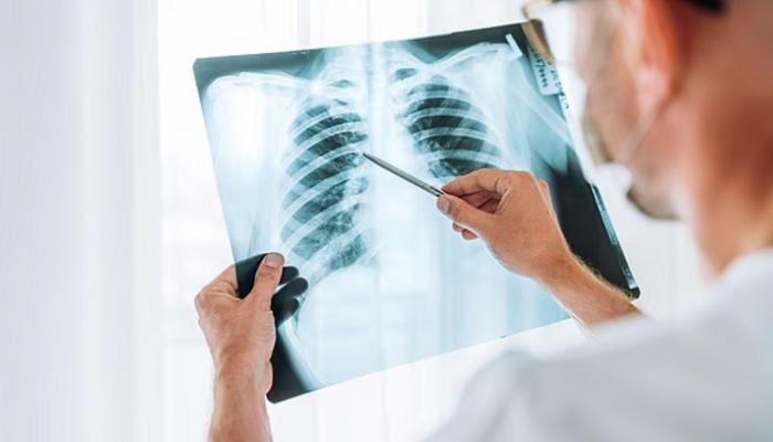 الإنفلونزا تحول رئتيك إلى ساحة معركة حياة أو موت