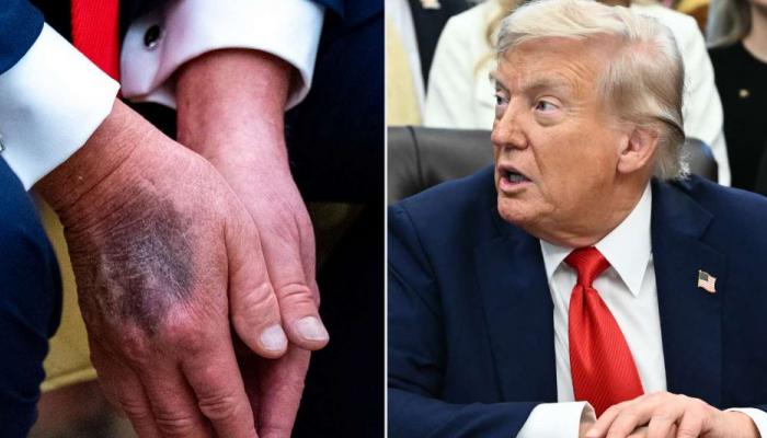 كدمات على يد ترامب