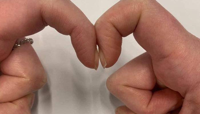 وجود الفتحة الصغيرة بين الأظافر مؤشر صحي وغيابها يدعو للقلق