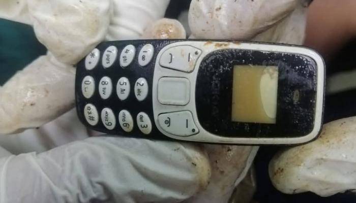 هاتف محمول في معدة مريض منذ عامين