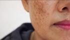 یک آزمایش یک دقیقه‌ای خطر ابتلا به سرطان پوست را نشان می‌دهد