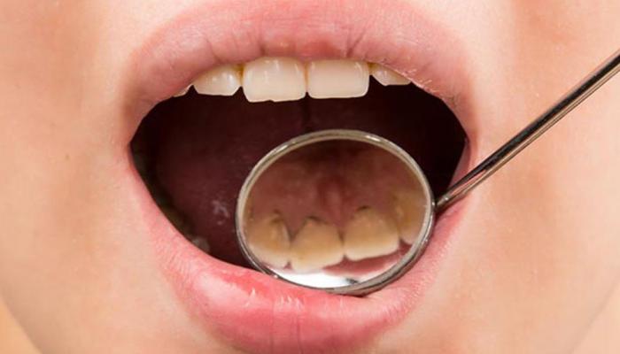 ابتكار أغشية تذوب في الفم لإصلاح الأسنان