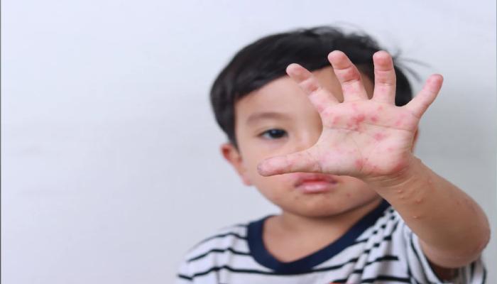 مرض اليد والقدم والفم