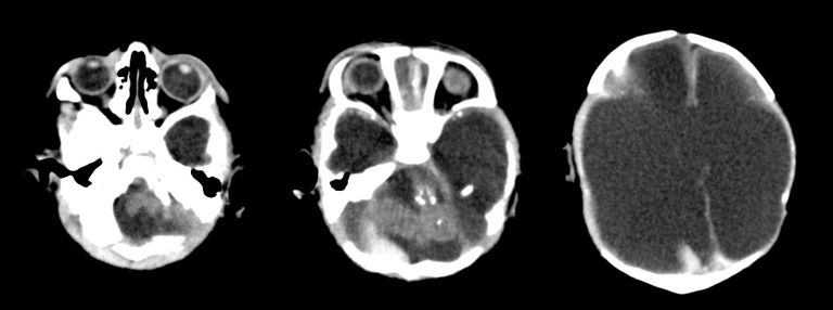 صور أشعة مخ لأطفال برازيليين تظهر تأثير 