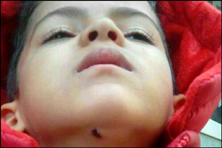 امرأة تلد توأماً في مستشفى إيراني فتحترق بغاز سام