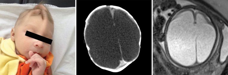 صور أشعة مخ لأطفال برازيليين تظهر تأثير 