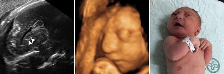 صور أشعة مخ لأطفال برازيليين تظهر تأثير 