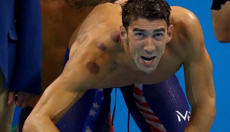 لاعبو الأولمبياد يظهرون بعلامات الحجامة على أجسادهم