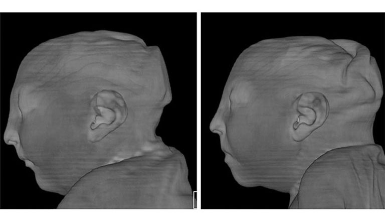 صور أشعة مخ لأطفال برازيليين تظهر تأثير 