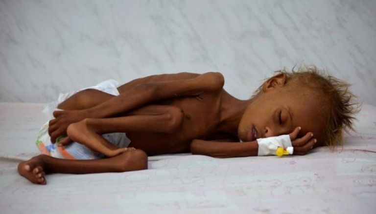 طفل يمني يعاني من سوء التغذية في وحدة للعناية المركزة في مدينة الحديدة