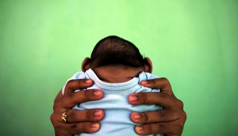 طفل مصاب بصغر حجم الرأس بسبب زيكا