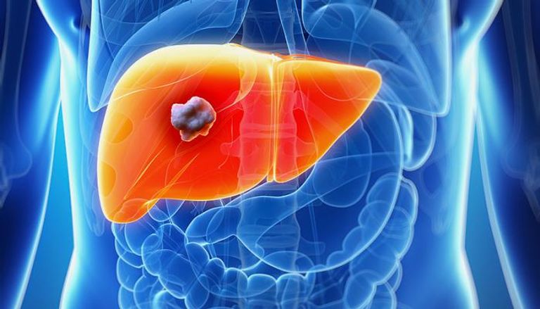 الكبد الدهني قد يتطور إلى الإصابة بالسرطان