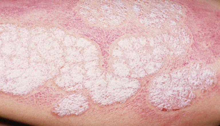 مرضى الصدفية أكثر عرضة للنوبات القلبية والوفاة