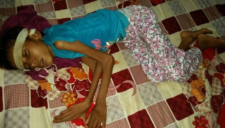 الأطفال أكثر المتضررين من المجاعة في اليمن