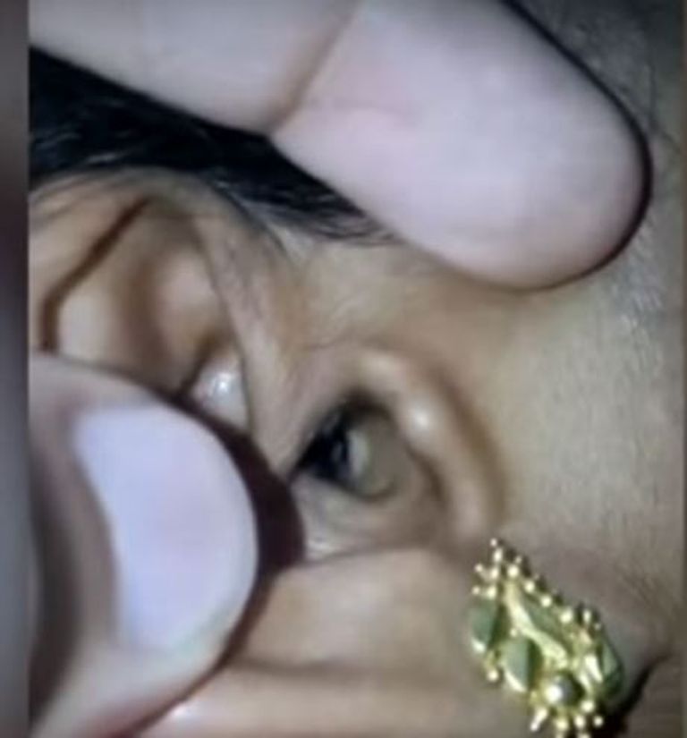 بالفيديو.. عنكبوت في أٌذن امرأة هندية