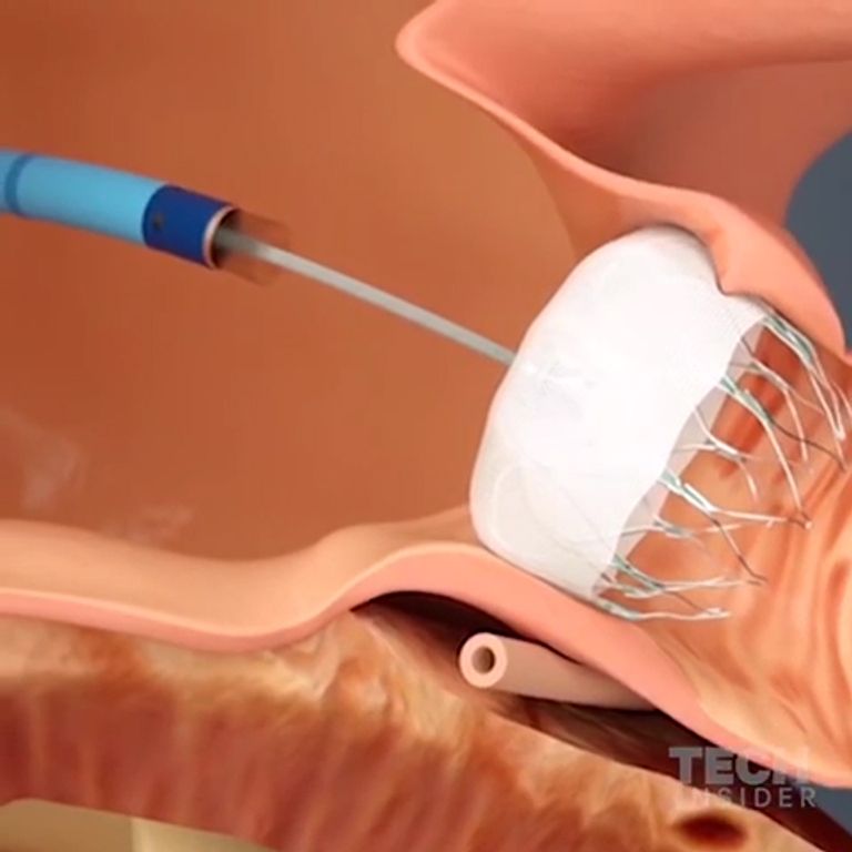 زراعة فلتر لمنع جلطات الدماغ