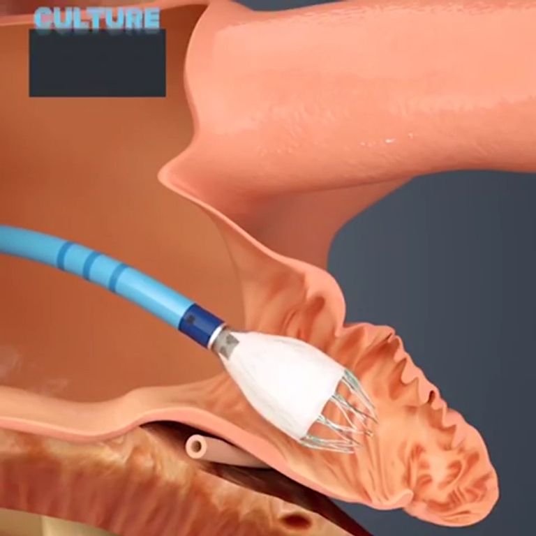 زراعة فلتر لمنع جلطات الدماغ