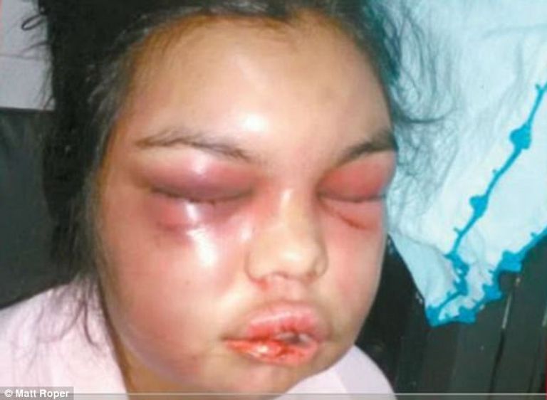 خضعت الزوجة لعمليات ترميمية في أنفها وشفتيها