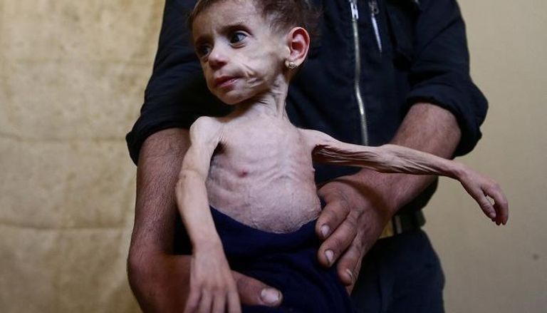 آثار المجاعة تظهر على أطفال الغوطة الشرقية