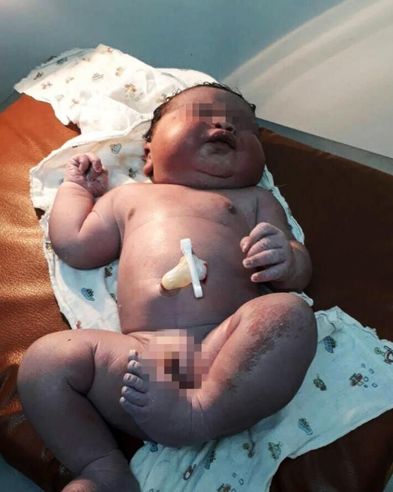 لم تتخيل الأم أن بطنها تحمل طفلا بهذا الحجم -أرشيفية