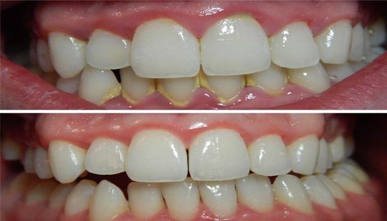 وصفات لإزالة الجير من الأسنان