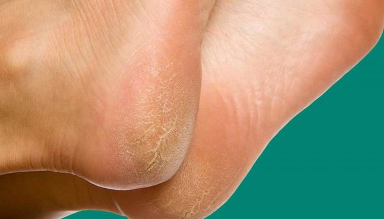 الالتهابات الفطرية السبب الأكثر شيوعا لتشقق القدمين
