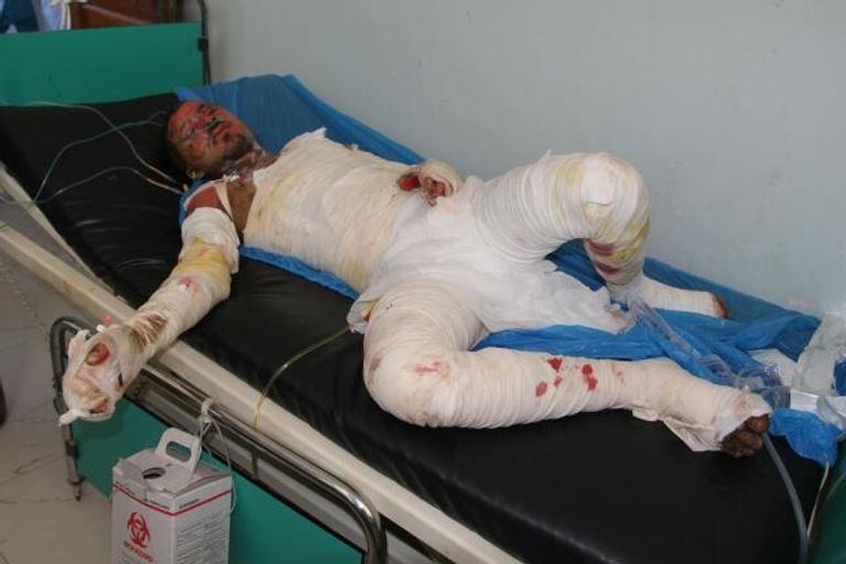 الحوثيون يحرقون اليمنيين بالحديدة