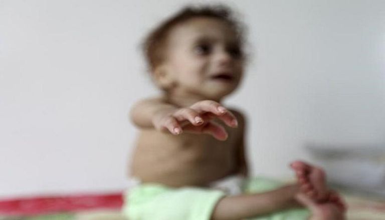 طفل يعاني من سوء التغذية نتيجة الجوع في اليمن