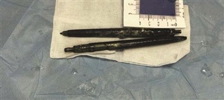 طبيب يزيل قلمين من أمعاء رجل