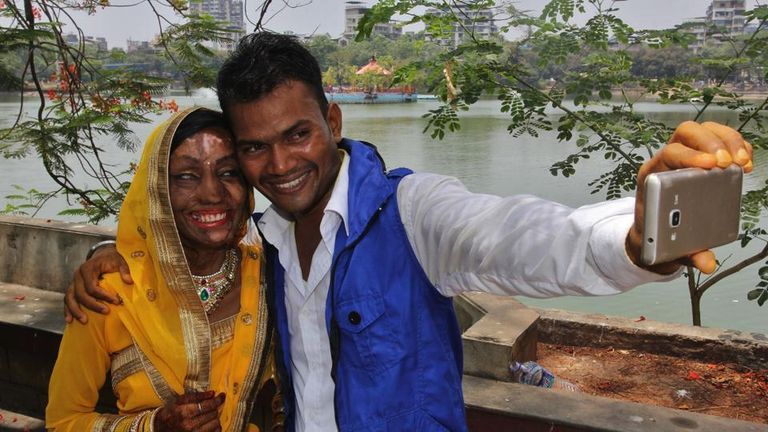 العروس ضحية الهجوم الحمضي