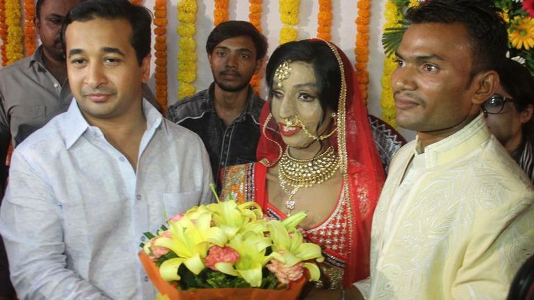 العروس ضحية الهجوم الحمضي