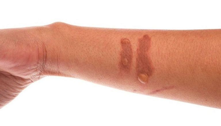 6 عوامل تؤدي إلى زيادة احتمالية الإصابة بسرطان الجلد