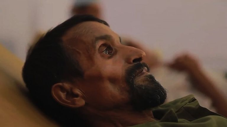 مصابون بالكوليرا في اليمن