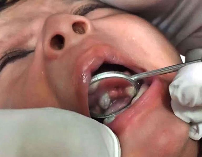 أطباء في الهند ينتزعون 7 أسنان من فم طفل في عمر شهر